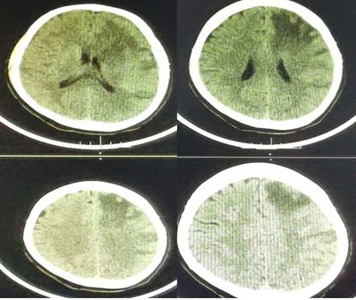 Rasmussen脑炎、结核性肉芽肿、脑发育性静脉畸形丨3分钟读片·第13期,下）