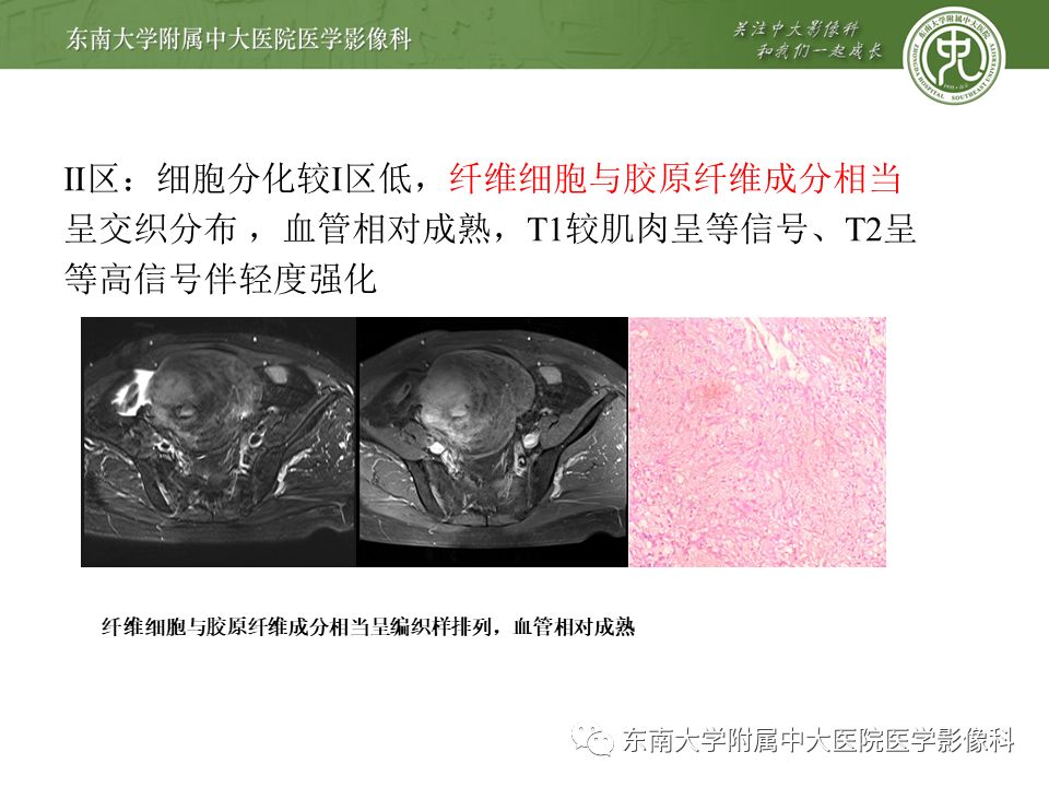 侵袭性纤维瘤影像学表现,侵袭性纤维瘤病影像上易诊断吗