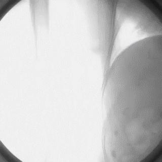 冠脉造影技术成熟不,跟我学技术分析从入门到精通