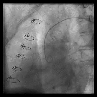 冠脉造影技术成熟不,跟我学技术分析从入门到精通