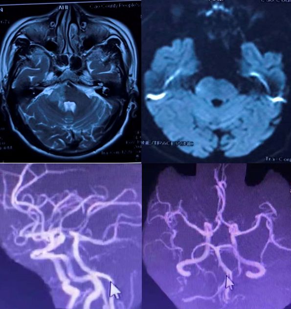 平山病、MELAS、MVNT、ODS丨3分钟读片·第15期