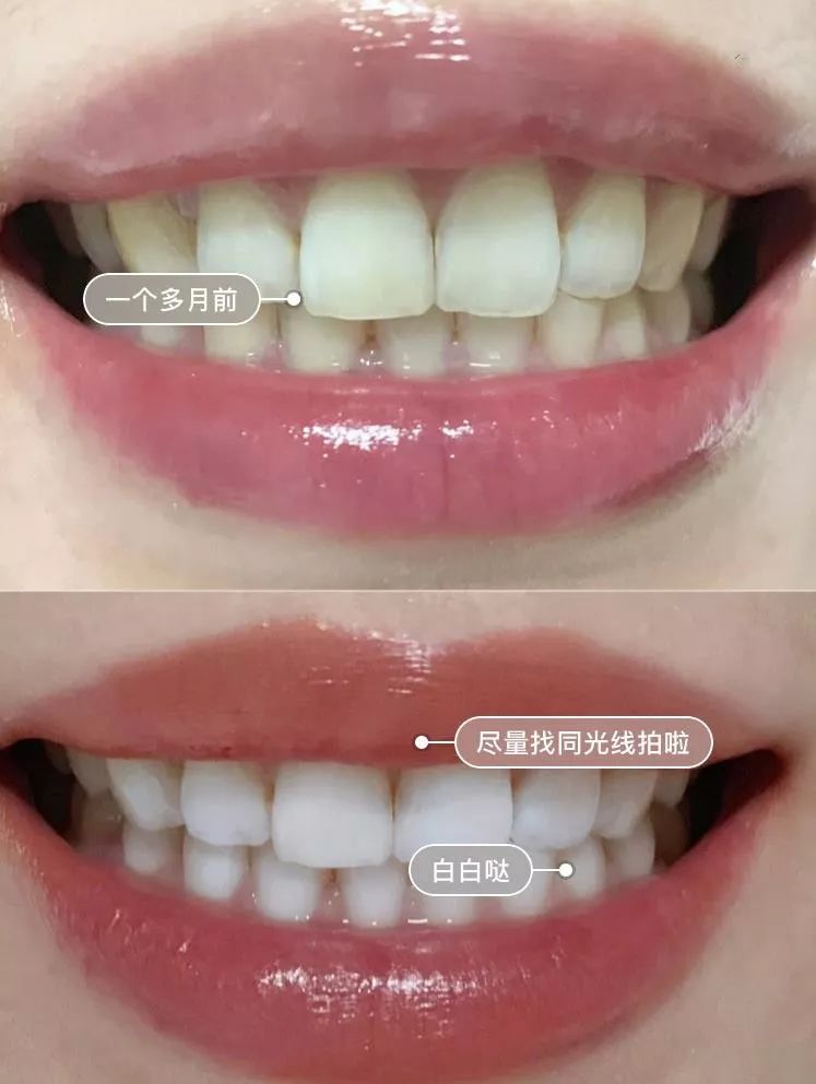 去除黄牙牙垢的牙膏,去口臭黄牙牙垢的牙膏