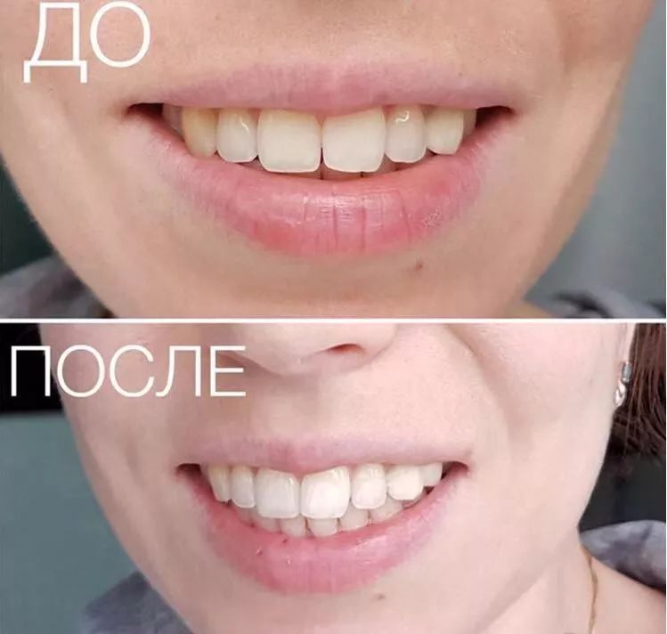 去除黄牙牙垢的牙膏,去口臭黄牙牙垢的牙膏