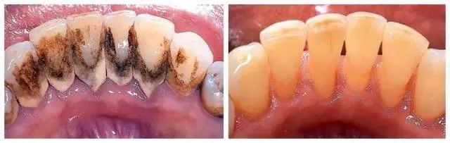 牙到底横着刷还是竖着刷,刷漆横着刷还是竖着刷