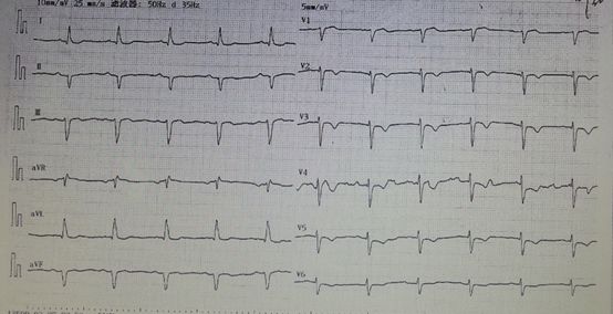 缺血性心肌病心衰恢复,缺血性心衰能逆转吗