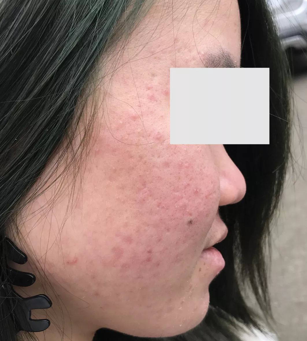 哪个牌子的壬二酸凝胶好,首博尔壬二酸清痘凝胶副作用