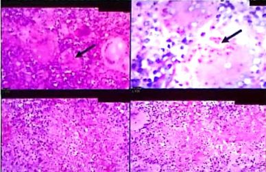 这例患者是呼吸道感染吗？｜病例分享