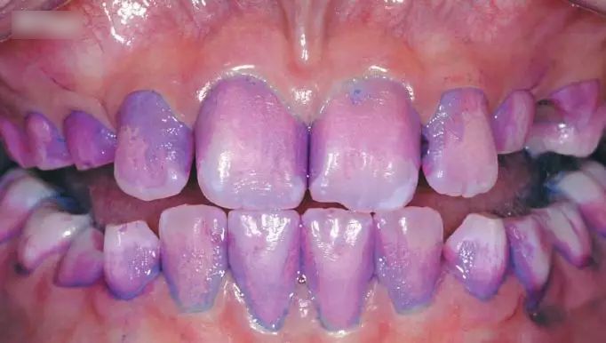 9成中国人没见过，洗牙就用1分钟，美国人用了很久的洁牙神器