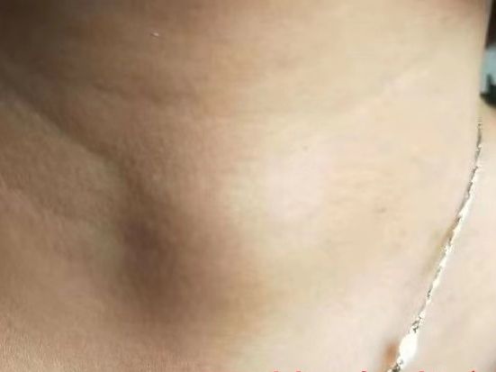 腔镜甲状腺外科手术简介,腔镜甲状腺手术适应症及美容效果