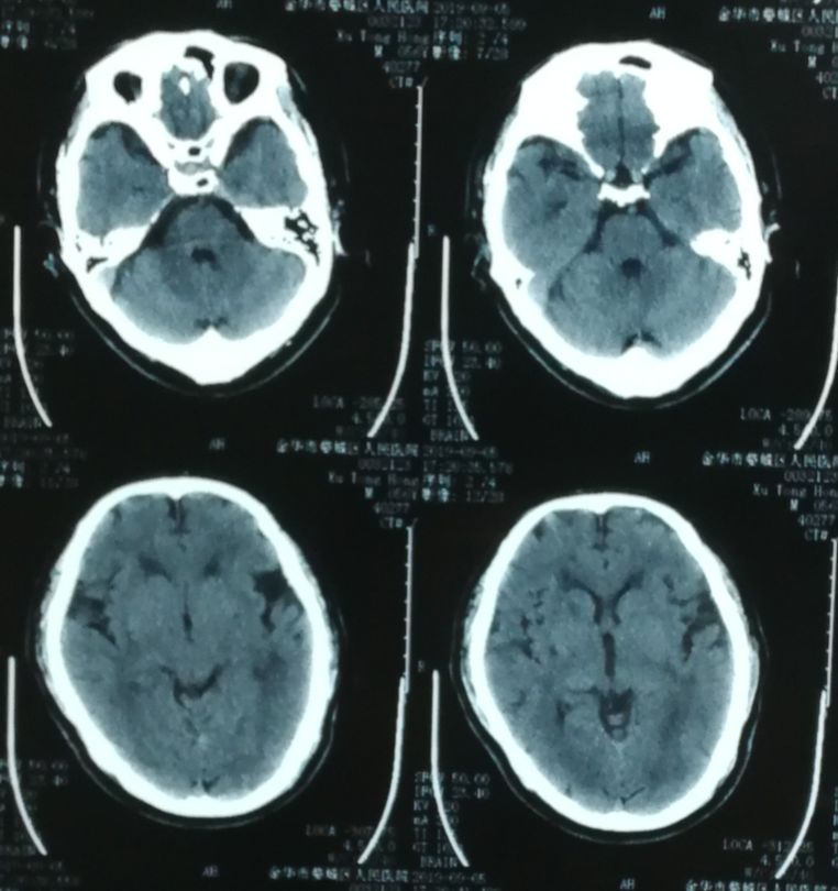 中医治疗脑夹层动脉瘤,3d演示夹层动脉瘤支架治疗
