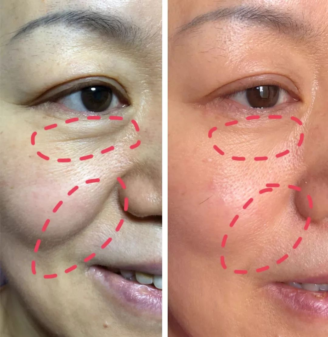 眼膜贴八小时紧致抗皱淡细纹,官方眼膜紧致抗皱淡细纹法令纹