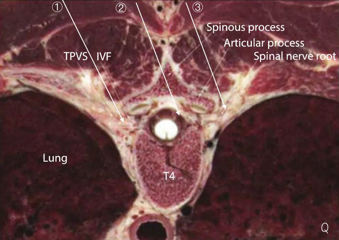 胸椎旁神经阻滞时需要穿过的韧带,胸椎旁神经阻滞超声探头位置
