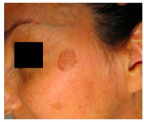 祛斑最有效是仪器还是产品,公认的祛斑第一名食物