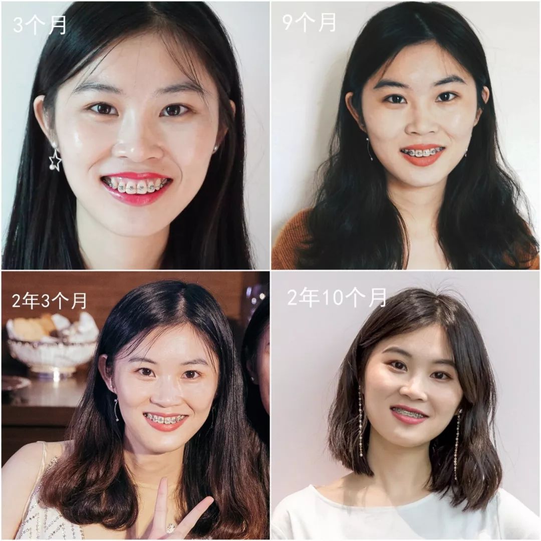 摘掉牙套后颜值会提高吗,戴完牙套颜值飙升