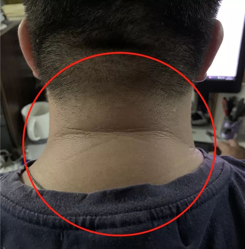 脖子后面有一条夺命纹,脖子有夺命纹是什么原因