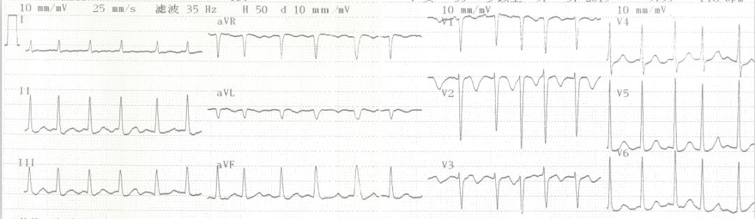 专栏丨贾卫滨：心电图“掉头”现象的鉴别诊断与发生机制（3）