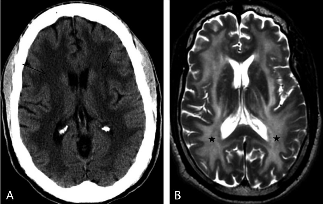 高氨血症有哪些表现,高氨血症