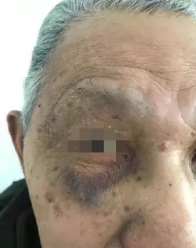 「气愤」娶了小35岁保姆后，92岁退休老师被殴打多处骨折，只能住养老院…