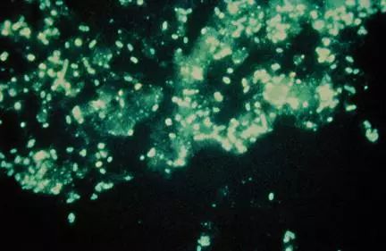 26张图，搞懂细菌性肺炎与病毒性肺炎