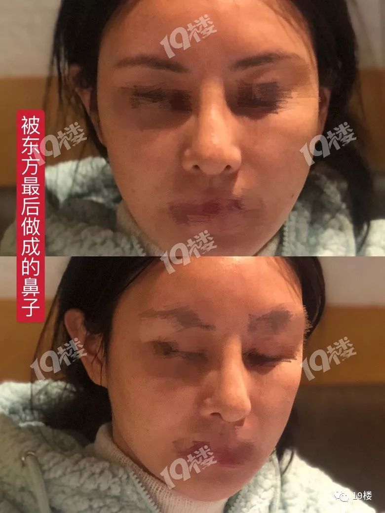 美丽女子整容失败,鼻整形失败多久可以修复