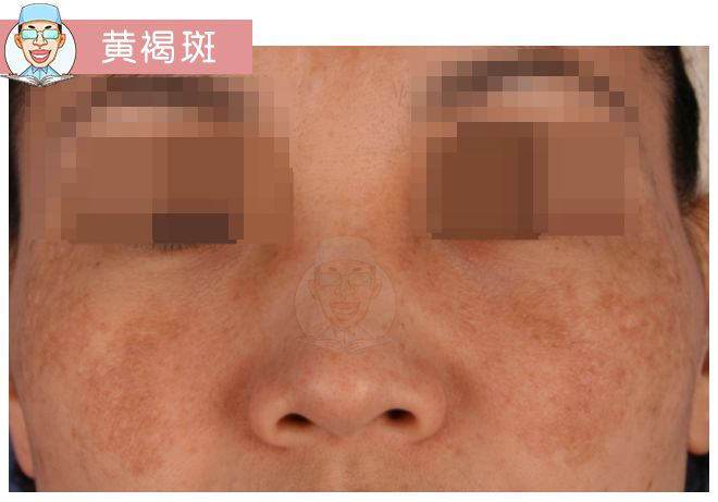 褐青色痣和斑的区别,褐青色痣斑是怎么形成的