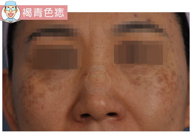 褐青色痣和斑的区别,褐青色痣斑是怎么形成的