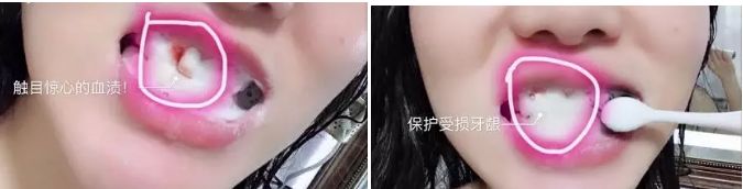 牙龈肿了出血口臭牙黄用什么牙膏,牙龈上火牙膏