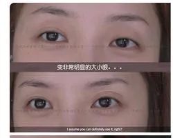 angelababy的双眼皮是什么情况,angelababy的脸整过容吗