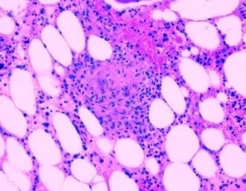 肺部感染鉴别诊断病例,双肺感染病例报告