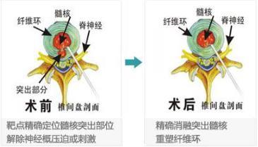 腰间盘突出微创介入治疗效果怎样,腰椎间盘突出微创介入治疗有哪些