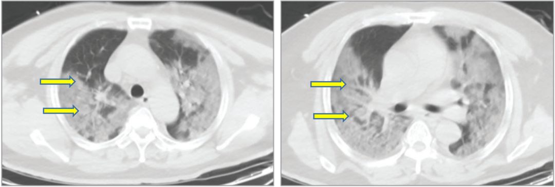 新冠细胞因子风暴会引起什么,新冠肺炎细胞因子风暴解说视频