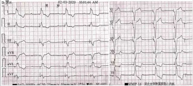 病例丨“一波三折”的三度房室传导阻滞，原因何在？