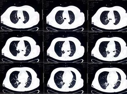 一度房室传导阻滞是怎么得的,三度房室传导阻滞最简单看法