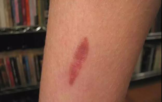 儿童开水烫伤急救处理,被开水烫伤怎么办最快最有效