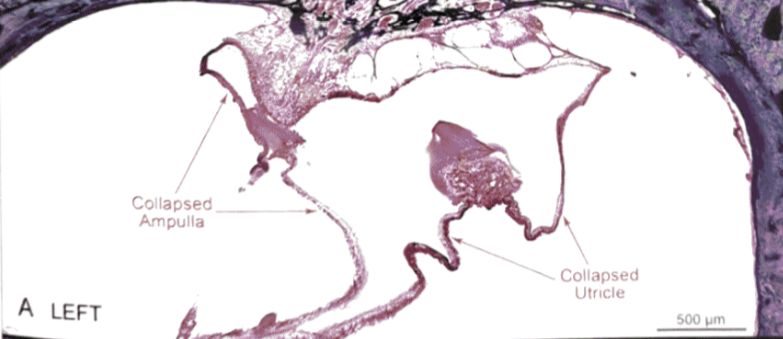 梅尼埃病深度解析,梅尼埃病病理解剖