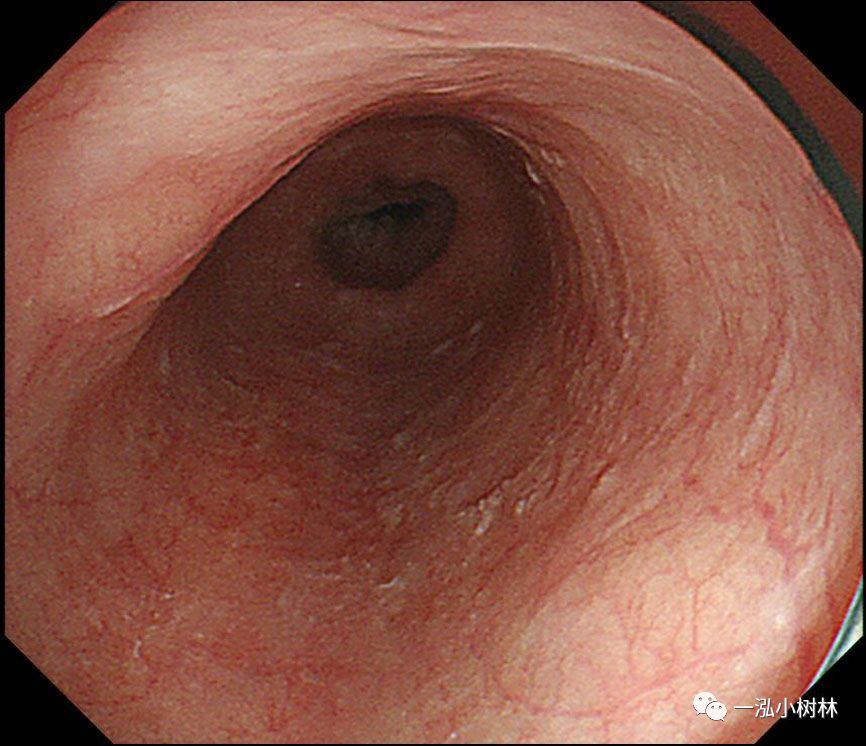 食管癌早期内镜esd治疗能活多久,食管癌内镜esd手术后几天出院