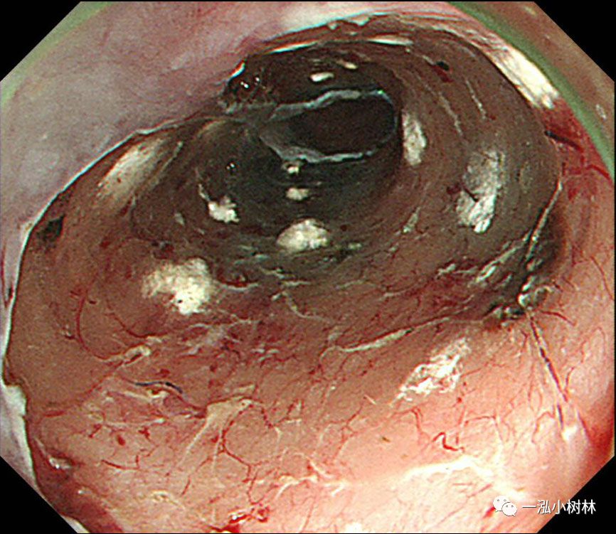 食管癌早期内镜esd治疗能活多久,食管癌内镜esd手术后几天出院