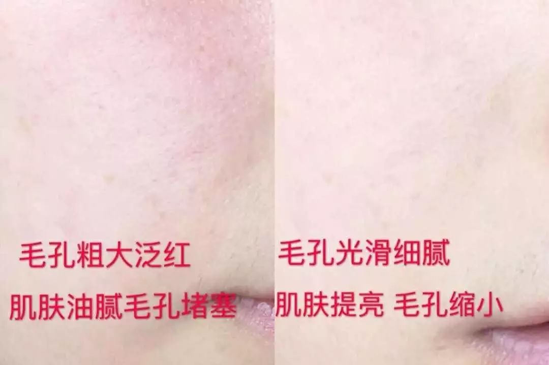 10鍒嗛挓娓呴櫎榛戝ご绮夊埡,榛戝ご绮夊埡鎸ゅ帇娓呯悊姣涘瓟绮楀ぇ