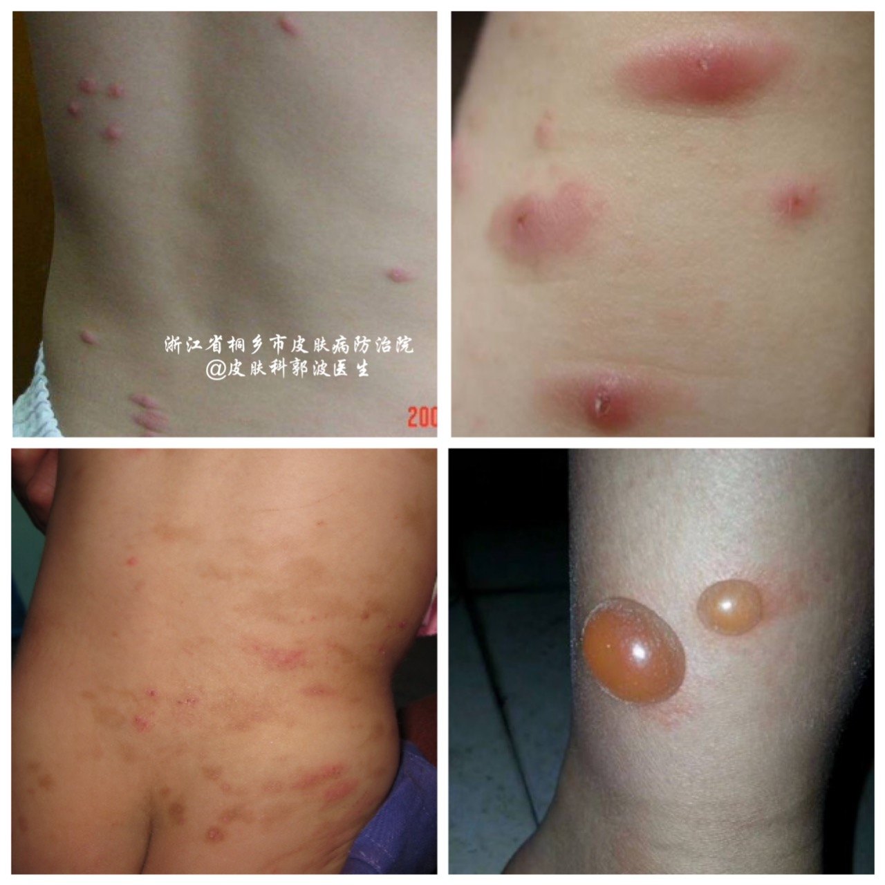 丘疹性荨麻疹的最佳图片,丘疹性荨麻疹防治措施