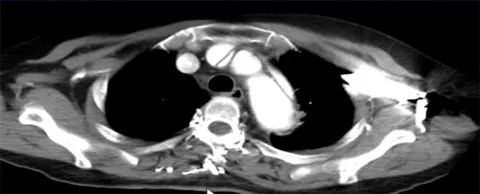 主动脉夹层真假腔鉴别超声示意图,主动脉夹层诊断中国专家共识