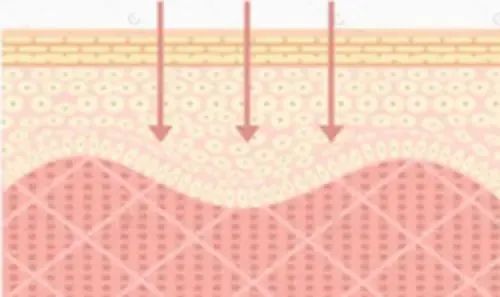 嘴唇干裂起皮等皮掉了涂唇膏,嘴唇干脱皮用什么唇部护理比较好?
