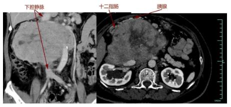 胃口差新冠,胃口变好新冠