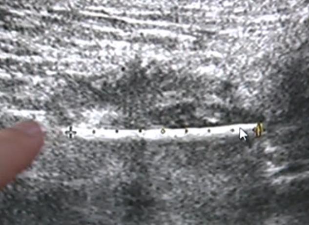 女士长了痔疮,女子得痔疮痛不欲生