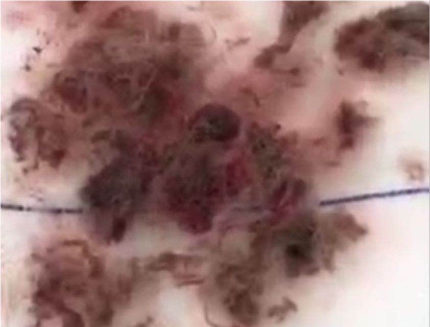 临沂一岁女孩患病,小女孩感染妇科病新闻