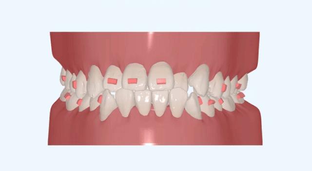 深拔牙齿矫正的潜在风险,隐形牙套的坑