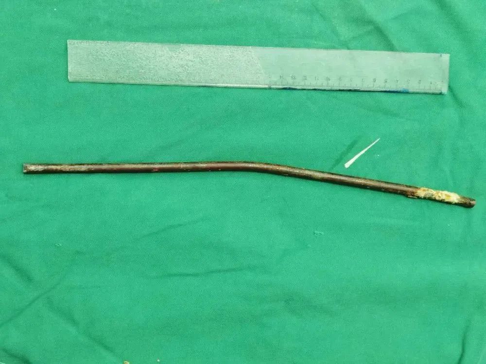 男子35厘米钢筋直穿腹部内脏！惠东医生上演生死时速