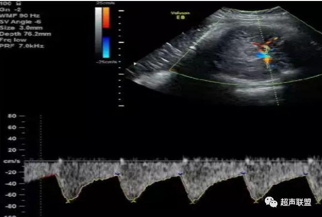 胎儿宫内窘迫通过什么检查出来的,胎儿宫内缺氧的超声视频