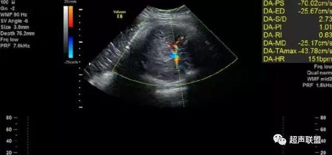 胎儿宫内窘迫通过什么检查出来的,胎儿宫内缺氧的超声视频