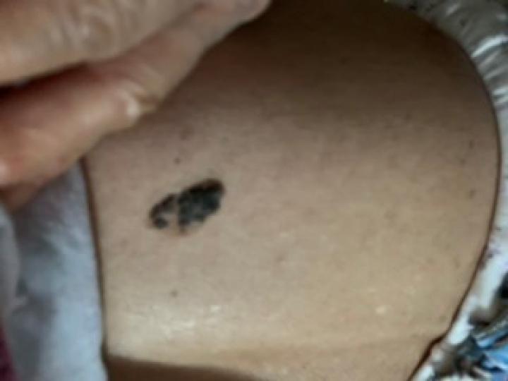 黑痣癌变的10个征兆,黑痣癌变从发病到去世不到两个月