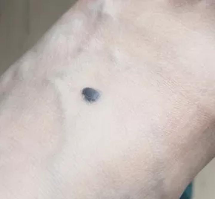 黑痣癌变的痣会很大吗,黑痣癌变一般是一个痣还是好多